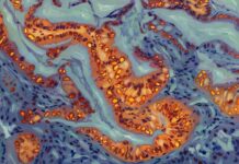 Genetischer Schalter zur Kontrolle der Chemotherapie-Resistenz bei Bauchspeicheldrüsenkrebs identifiziert