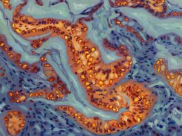 Генетичний перемикач, який контролює стійкість до хіміотерапії при раку підшлункової залози, ідентифікований