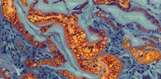 Генетичний перемикач, який контролює стійкість до хіміотерапії при раку підшлункової залози, ідентифікований