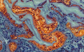 Генетичний перемикач, який контролює стійкість до хіміотерапії при раку підшлункової залози, ідентифікований