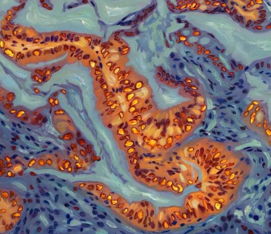 Генетичний перемикач, який контролює стійкість до хіміотерапії при раку підшлункової залози, ідентифікований