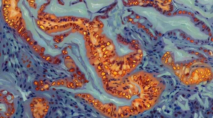 Genetischer Schalter zur Kontrolle der Chemotherapie-Resistenz bei Bauchspeicheldrüsenkrebs identifiziert