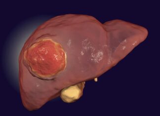 An FDA drug might fix immunotherapy’s blind spot for rare liver cancer