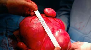 Pengertian Fibroid Uterus: Gejala, Resiko, dan Dampaknya pada Kesuburan